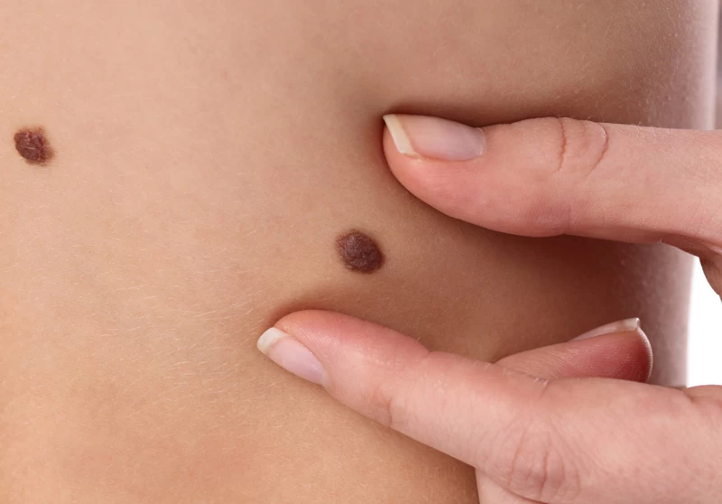 Pequenas cirurgias dermatológicas