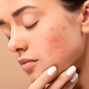 Como Tratar a Acne de Forma Eficaz: Dicas de uma Dermatologista