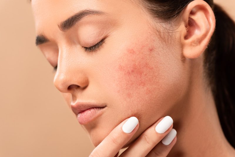 Como Tratar a Acne de Forma Eficaz: Dicas de uma Dermatologista