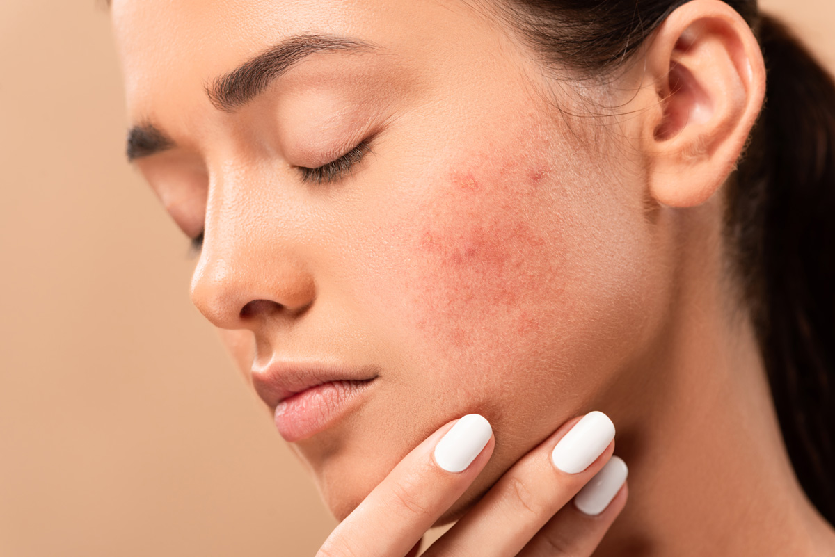 Como Tratar a Acne de Forma Eficaz: Dicas de uma Dermatologista