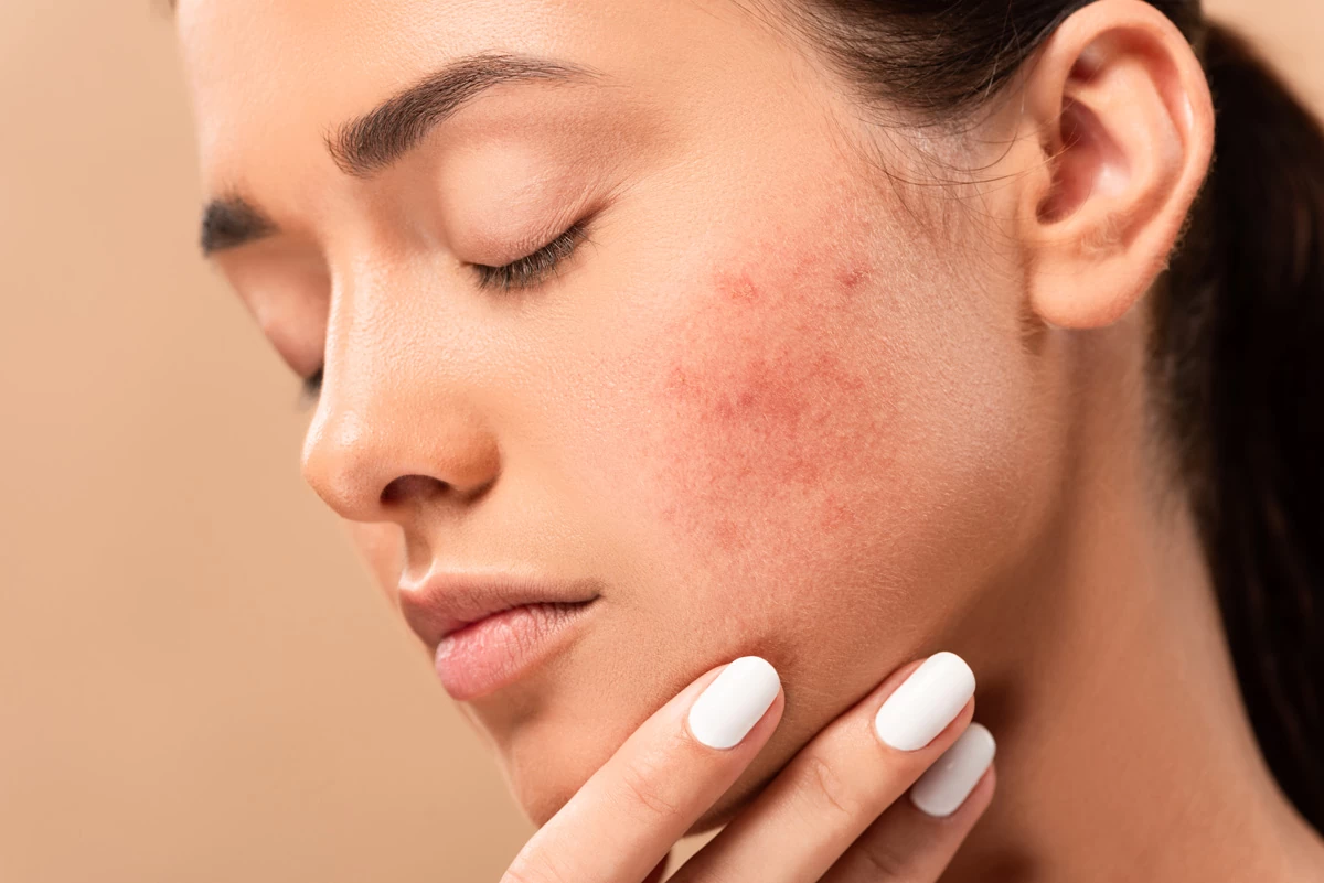 Como Tratar a Acne de Forma Eficaz: Dicas de uma Dermatologista