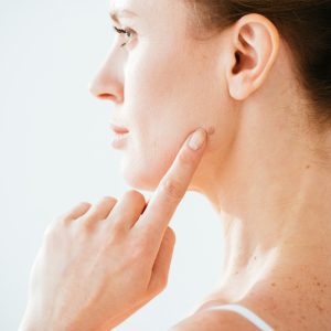 Minha pinta era um Melanoma. E agora?