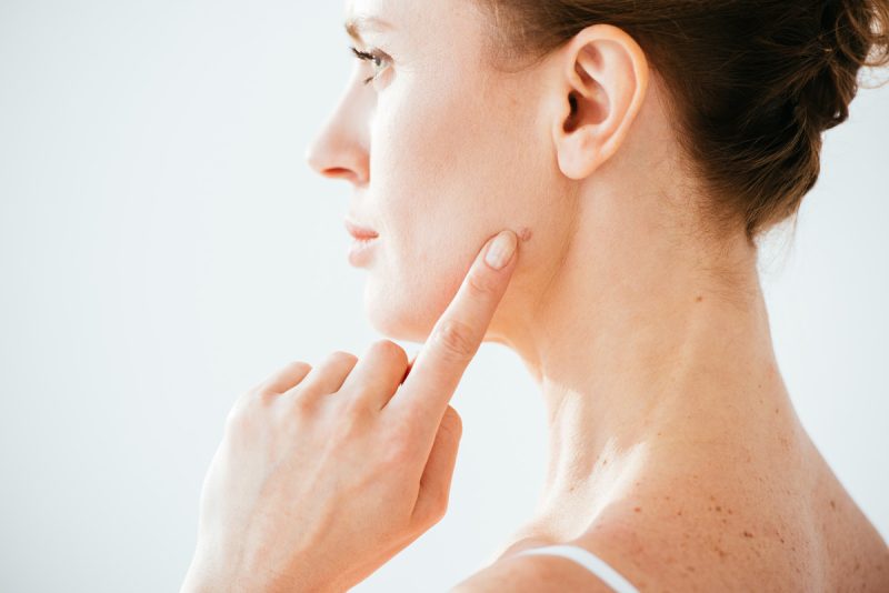 Minha pinta era um Melanoma. E agora?